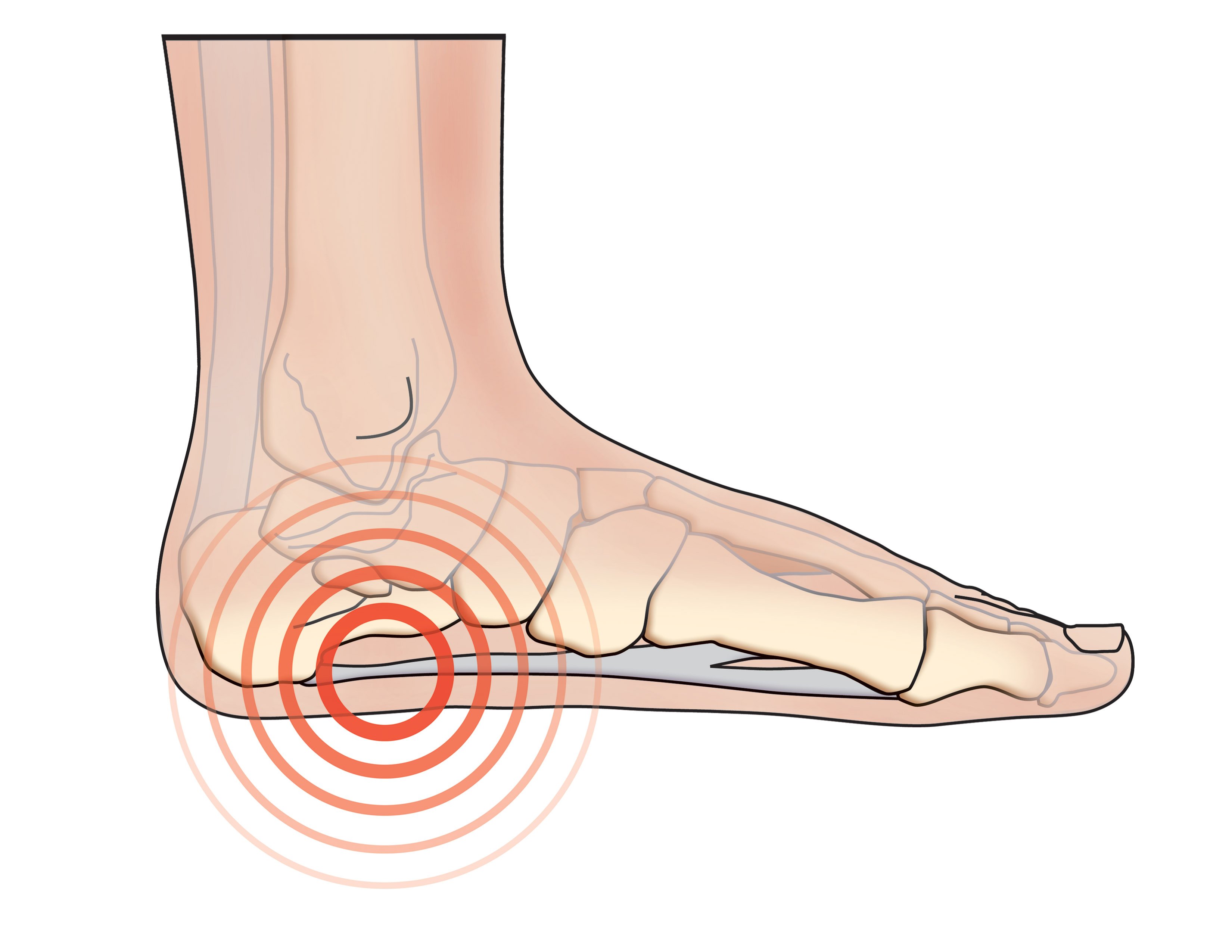 What is a Calcaneal Stress Fracture & How to Recover? - Upswing Health