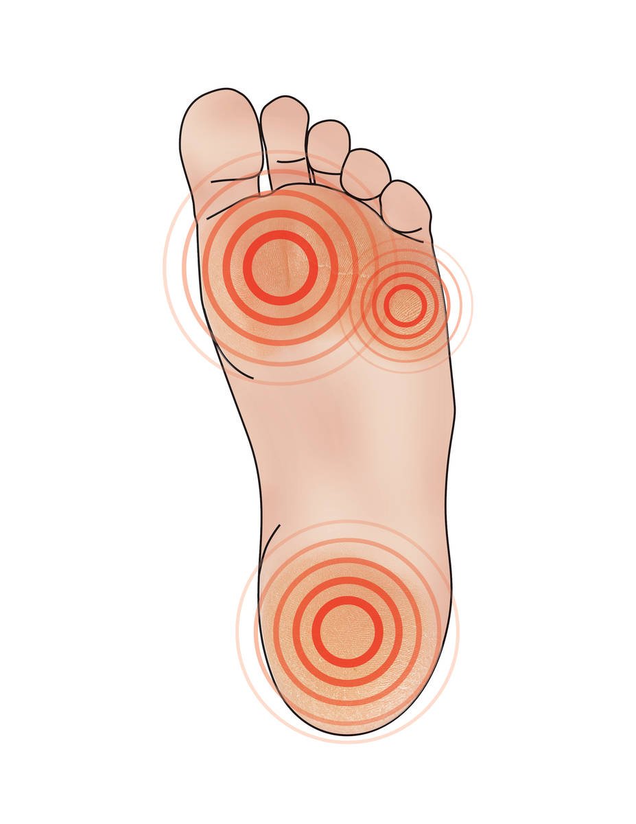 6 Tips To Eliminate and Prevent Foot Calluses – SigDevice