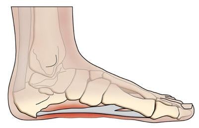 Symptoms of a Heel Spur