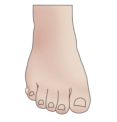 pinky toe bump