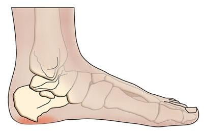 bone increase in heel