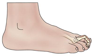 Crooked Toes