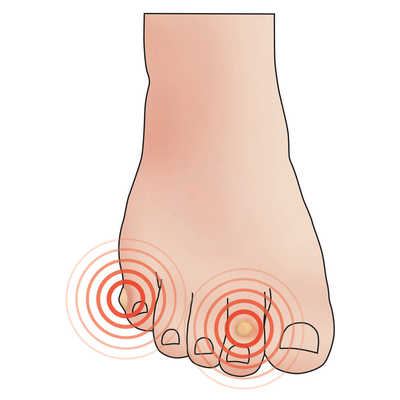 PediFix® Pedi-Patch™ Self-Adhesive Moleskin Foot Protection Pads