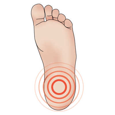 Plantar Fasciitis Symptoms | RICE Method Treatment | Lucky Feet Shoes