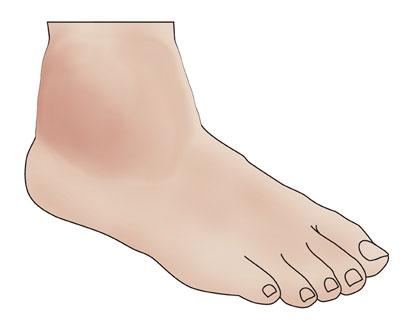 ankle sprain symptoms foot signs sprains pedifix